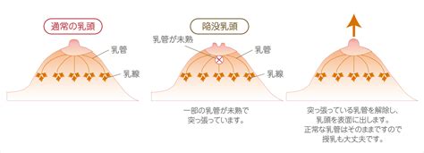 仮性陥没乳首|仮性陥没乳頭はどうやって治す？症状・治療方法を詳しく解説